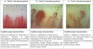 nailfold capillaroscopy