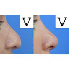 nose job boston changing your life with