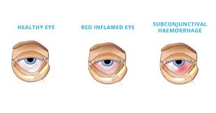 eye infection treatment eye allergy