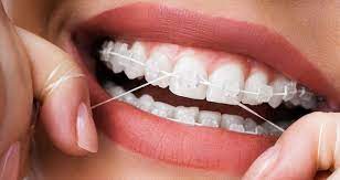 This type of floss will easily glide through the tight spaces between your teeth, dislodging plaque and debris, without shredding or getting stuck. Flossing With Braces How To Floss When You Have Braces The Orthodontists