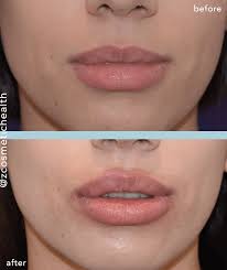 debunking the top 7 lip filler myths
