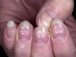 white spots from fingernails