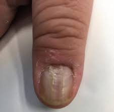 self induced nail disorders springerlink