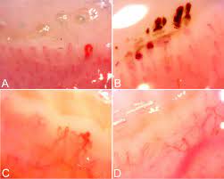 scleroderma pattern early a active