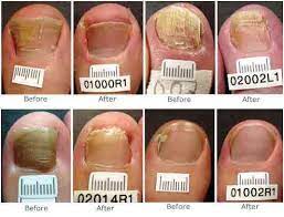 toenail fungus before and afters body