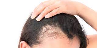 can sudden weight loss cause hair loss