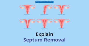 septum removal everything to know