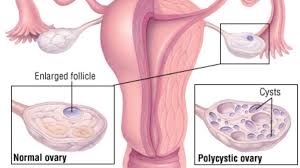 the polycystic ovary syndrome dr gan