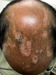 red spots on scalp causes treatment