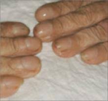 nail disorders and systemic disease