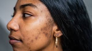 types of acne scars pictures of boxcar