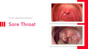 sore throat viral or bacterial