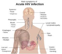 hiv symptoms and ses dr elist s