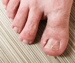 do you think your ingrown toenails