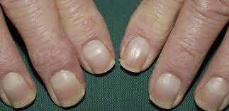 leukonychia what can white nails tell