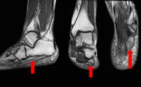 An mri will confirm the diagnosis and allow differentiation of other causes of masses in the foot, such as lipomas, ganglions, neuromas, herniations of the plantar fasica, and. Baxter S Nerve Entrapment Diagnosis Treatment Injection Surgery