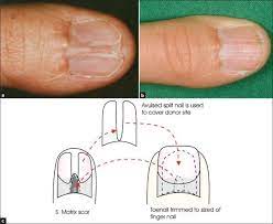 repair a split nail