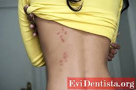 Ухапвания от бълхи са в допълнение, ухапванията от дървеници трябва да се разграничават от дерматологични. Uhapvaniya Ot Drvenici Snimki Lechenie I Profilaktika Medicinski