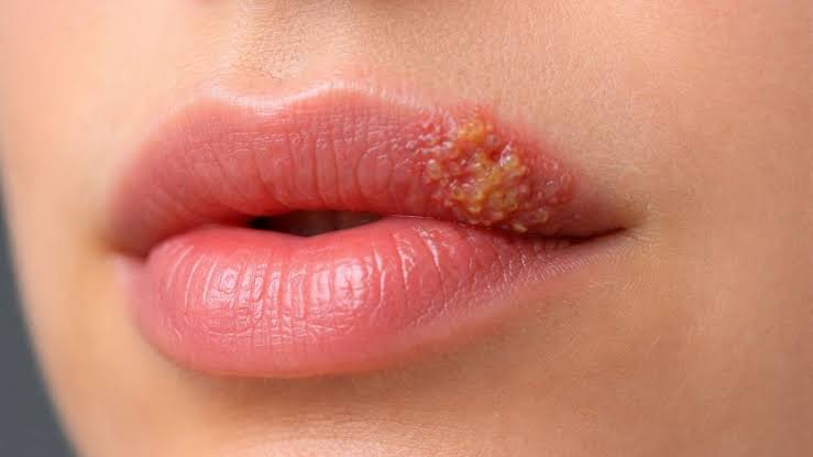 Herpès labial : ce qui est, les symptômes et comment venir à traiter