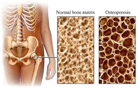 Osteoporosis and Exercise - Lamberti Physiotherapy