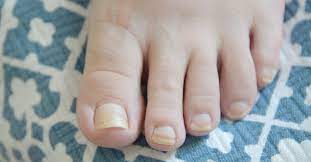 yellow toenails causes prevention