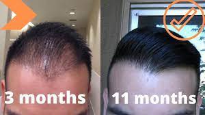 We did not find results for: When To Expect Growth After A Hair Transplant My Timeline Youtube