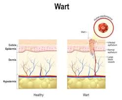 warts causes treatment and removal