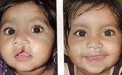 cleft lip surgery india low cost cleft