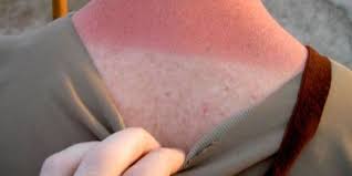 Anatomy Of A Sunburn A Timeline Of Dermatological Destruction