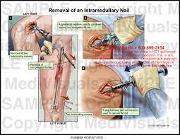 intramedullary nail