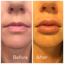 how to get kylie jenner s lips at home