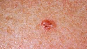 spotting the signs of skin cancer