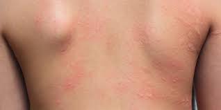 allergic contact dermais treatment