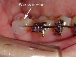 Your choice can be based on the color of wax, or on the most available product. Emergency Care Goldreich Orthodontics Plano Tx