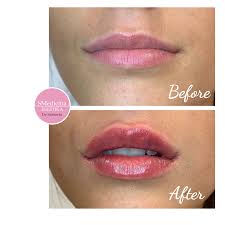 lip augmentation estetika scina