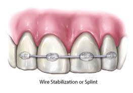 Periodontal stabilization splints are used to stabilize teeth which have become loose as a result of losing the supporting bone around them to periodontal disease, a condition known as secondary occlusal trauma.frequently the problem is complicated by heavy bite stress. Splinting Subha Dental Clinic