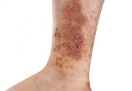 dark spots on legs