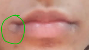 white patch in my lips edge after