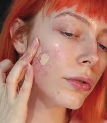 acne e skin