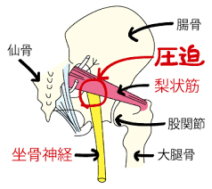 「座骨神経　」の画像検索結果