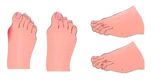 bent crooked toes tips for treatment