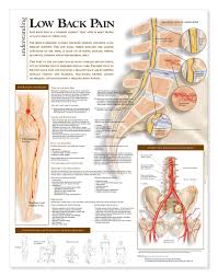 Understanding Low Back Pain Chart Poster Laminated