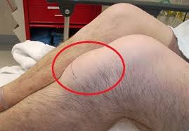 pain below the knee causes treatment
