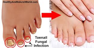 When using this type of solution, it's important to make sure your ratios are correct. Natural Cures For Toenail Fungus