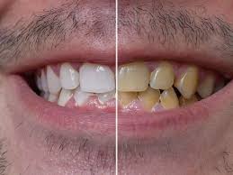 dental teeth whitening in singapore