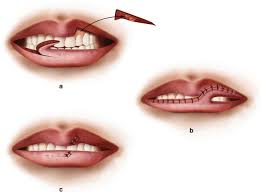 reconstruction of complex lip defects