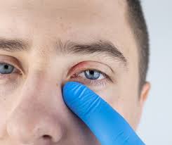 blepharitis dry eye home treatment mcli