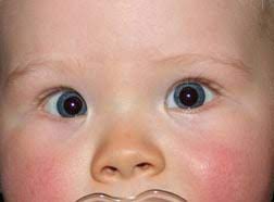 Upslanting palpebral fissures, a suggestion of epicanthal folds, and a flat nasal bridge. Pseudostrabismus American Association For Pediatric Ophthalmology And Strabismus