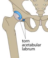 Is there an easy way to learn their a. Hip And Groin Injuries Unraveling The Mystery