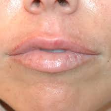 uneven lips with restylane or juvederm